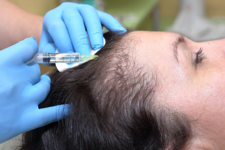 PRP for Hair Restoration